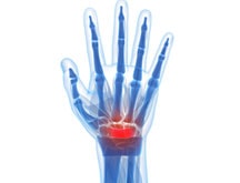 Wrist Fracture Treatment