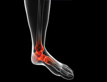 Ankle Sprain & Rolled Ankle Treatment in Burlington, ON