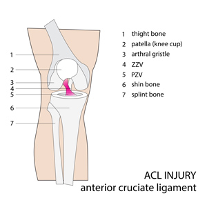 ACL tear