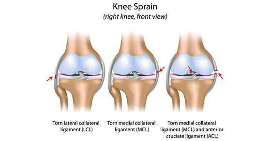 ACL Tears