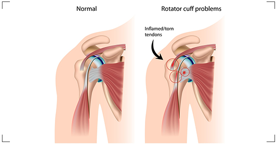 Shoulder Injury