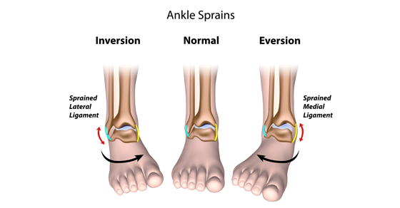 Acute Ankle Sprains