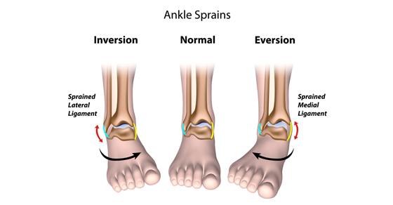 Ankle Sprain