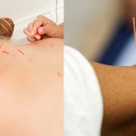 Acupuncture