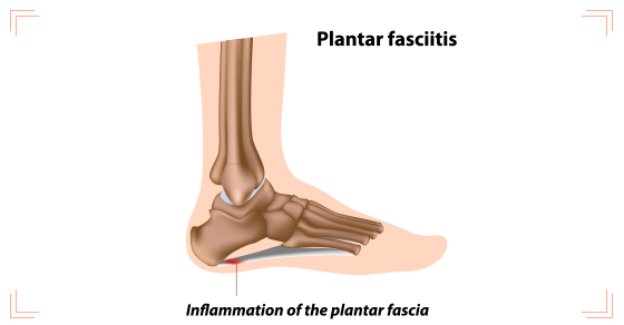 Plantar Fasciitis