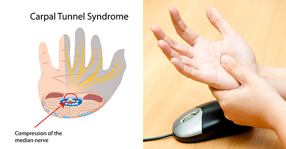 Carpal Tunnel Syndrome