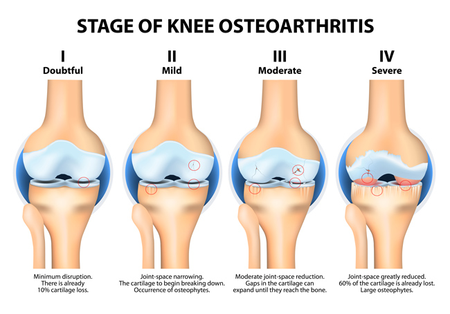 Stages Of Knee Osteoarthritis – PhysioNow