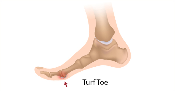 Foot Pain Treatment Mississauga
