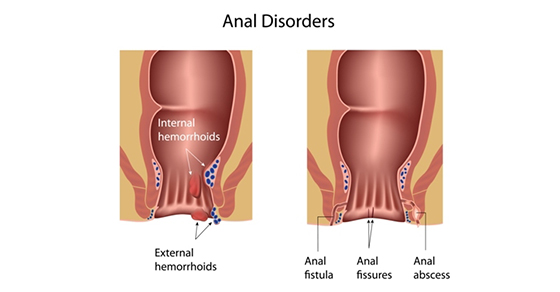 Anal Disorders