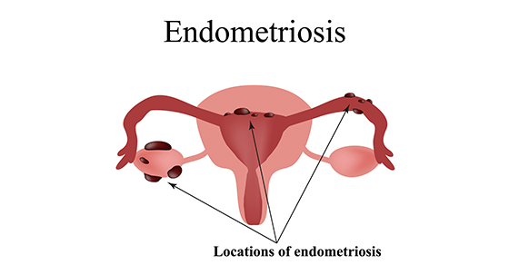 Endometriosis