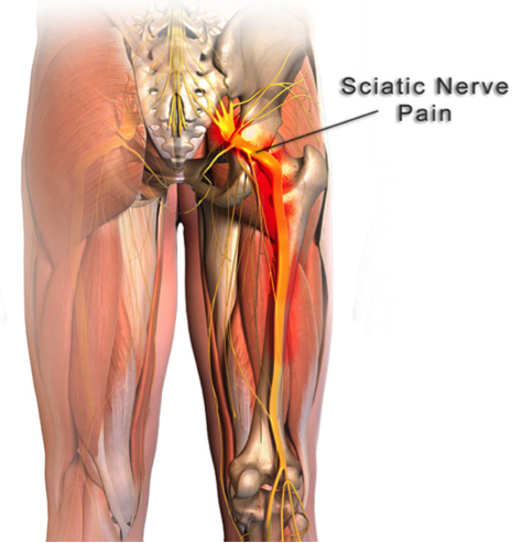 Sciatica Treatment Mississauga