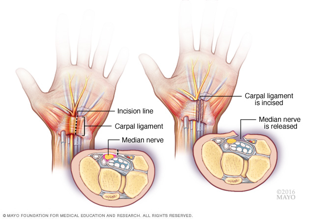 Carpal tunnel syndrome