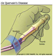 De Quervain's Disease