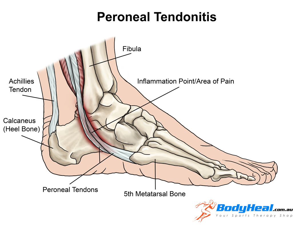 Peroneal tendinopathy