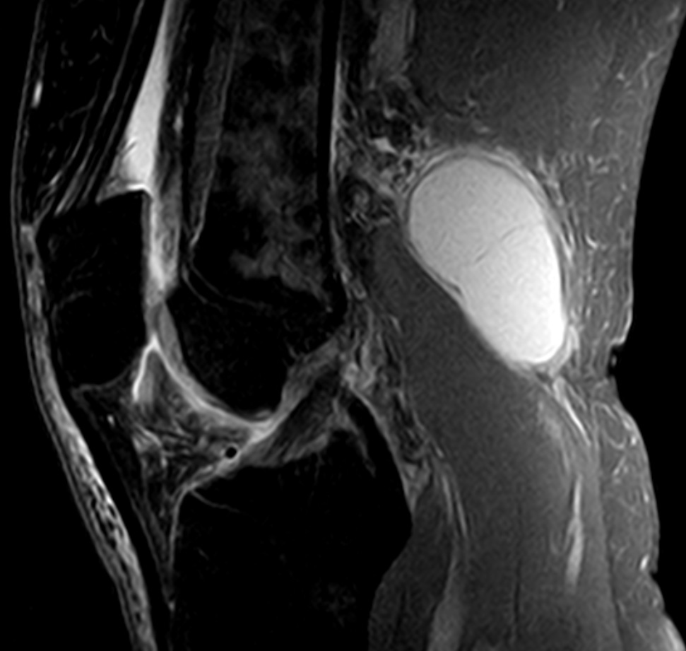 Baker's cyst