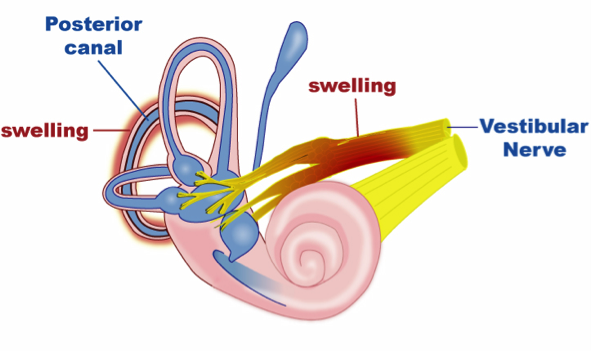 Labyrinthitis