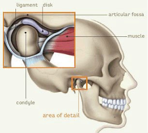 TMJ syndrome