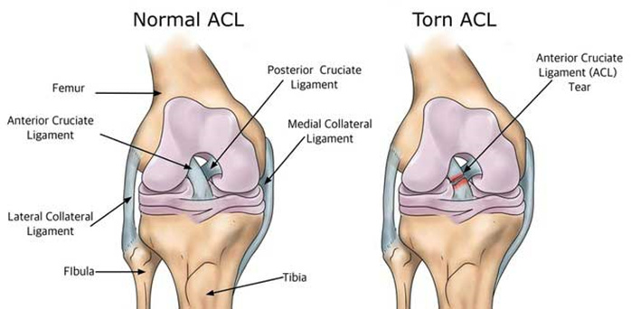 ACL Rehabilitation