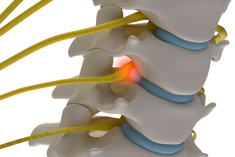 Neck Pain Treatments Mississauga, Etobicoke & Oakville