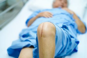 Total knee replacement
