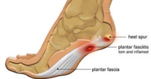 Heel spurs and plantar fascia