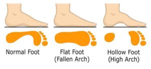 Risk factors for plantar faciitis