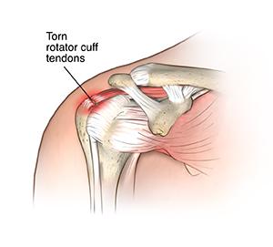  Injury in the shoulder