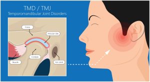 TMJ Pain Headache