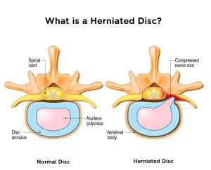 What is a Herniated Disc?