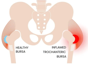 Inflamed bursa in hip bursitis