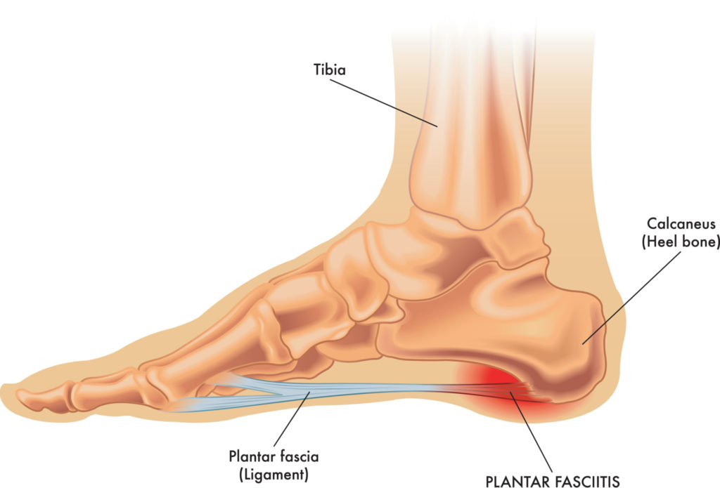 Physio 101: Plantar Fasciitis Care - PhysioNow