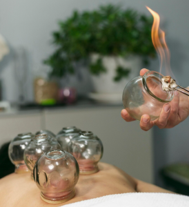 Cupping therapy on a patient