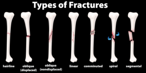 fractured bone types