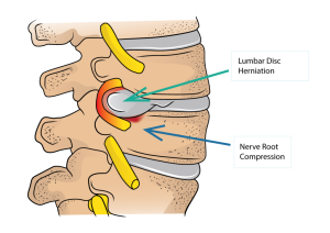 Lumbar disc herniation resulting in a pinched nerve