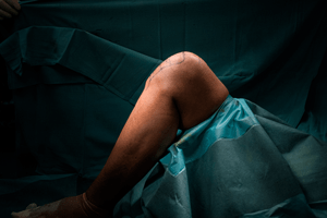 Total Knee Replacement Surgery