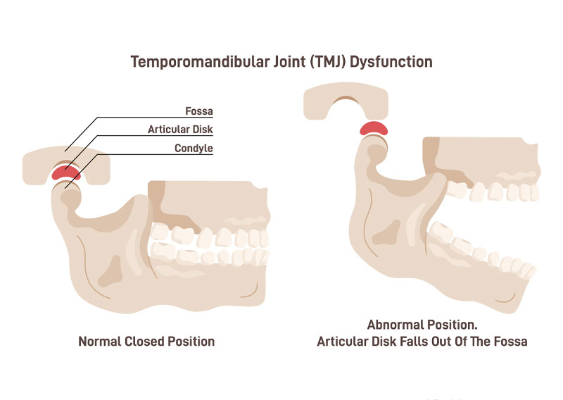 Temporomandibular Joint Dysfunction