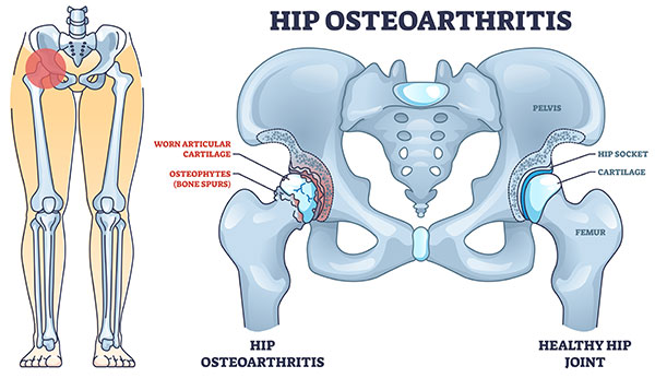 Hip osteoarthritis