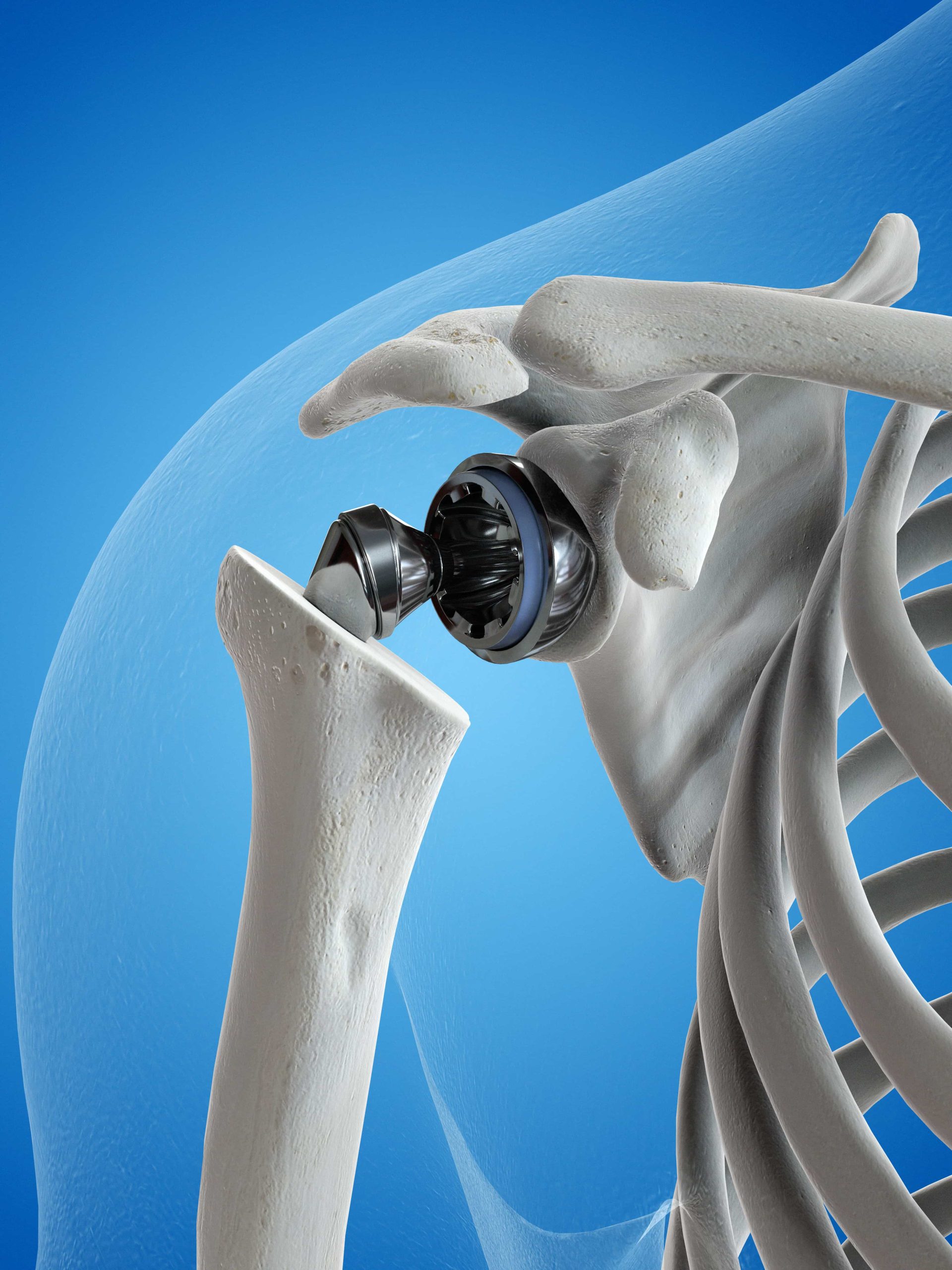 3D illustration of a shoulder replacement