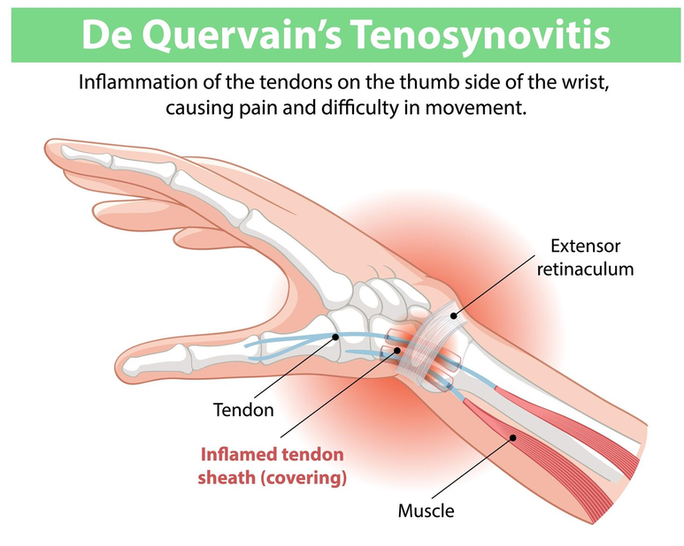 Diagram showing DQ, highlighting the inflammation fo the tendon and tendon sheath